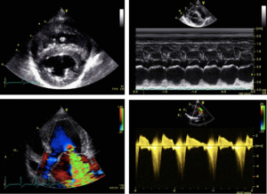 Echocardiographie Bidimensionnelle, TM et Doppler couleur et continu